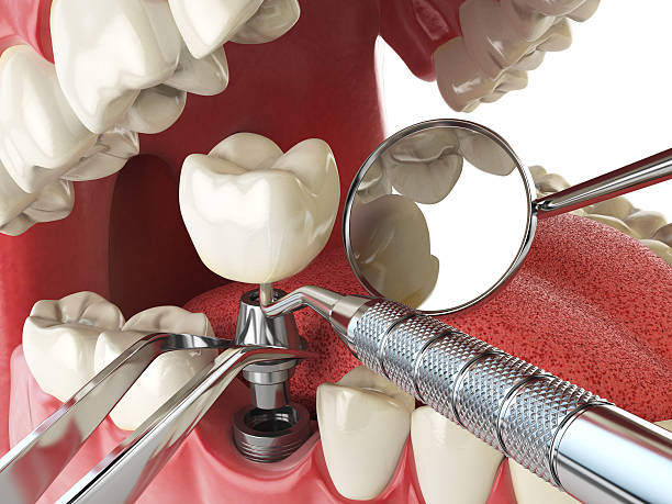 Best Emergency Root Canal Therapy in Way, NE